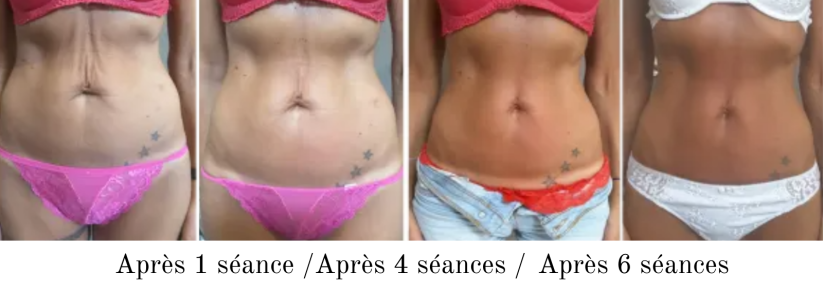 Après 1 séance INDIBA 