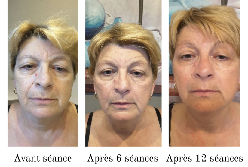 Séances INDIBA visage
