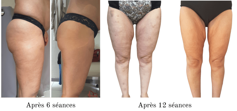 Séance INDIBA jambes