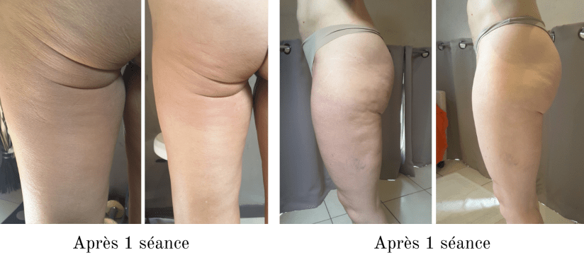 Séance INDIBA jambes