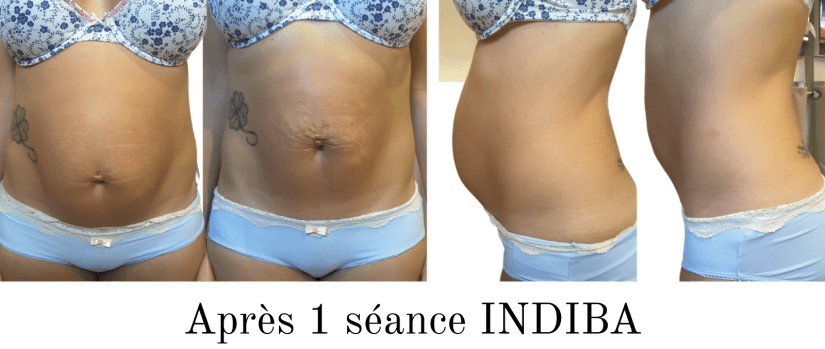 Après une séance INDIBA